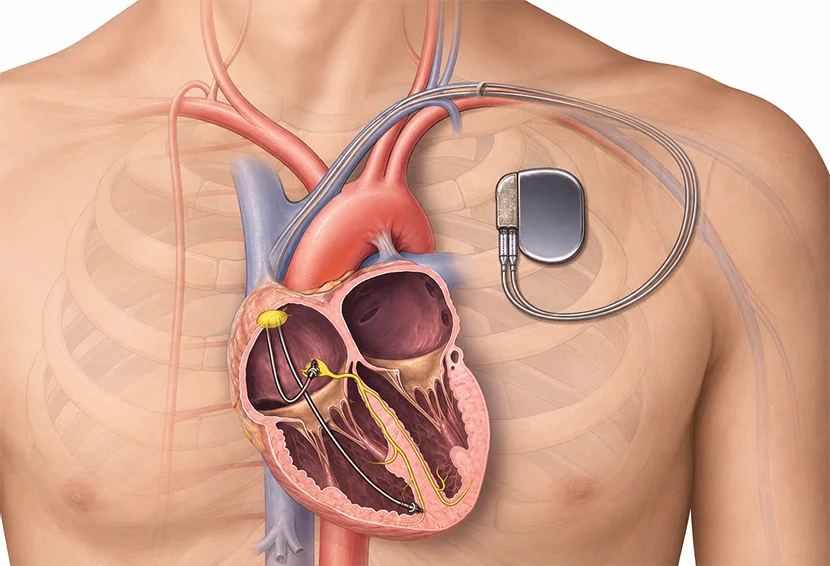 Why Does Chest Pain Happen Suddenly? Common Heart-Related Causes